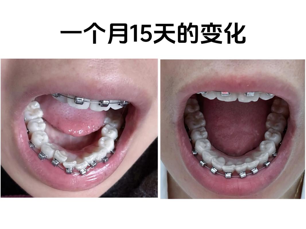 50岁还能矫正牙齿吗？中年正畸真实效果与风险解析