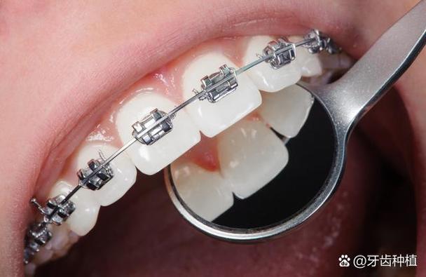 成人牙齿矫正好还是矫正_成人牙齿矫正好不好_成人矫正牙齿哪家好