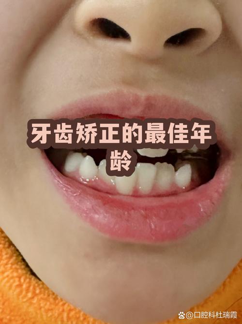 牙齿矫正晚上剧痛怎么办_16岁牙齿矫正晚吗_牙齿矫正晚上睡觉戴12个小时