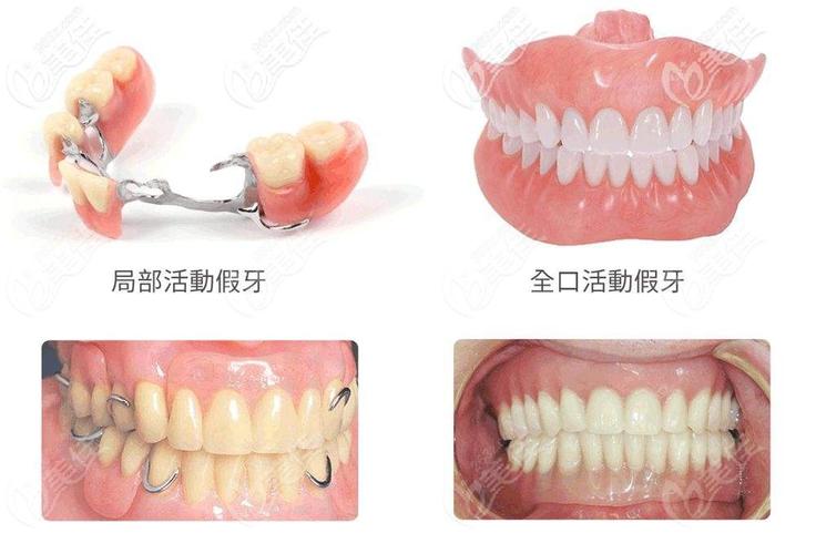 洛阳种牙多少钱？2026年2500-4700元到底靠不靠谱