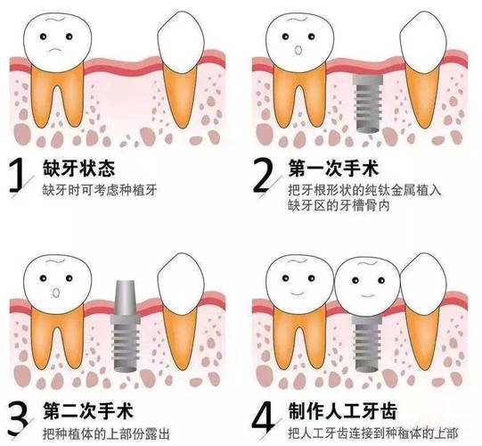 上海种植牙全过程揭秘:从挂号到戴牙多久?