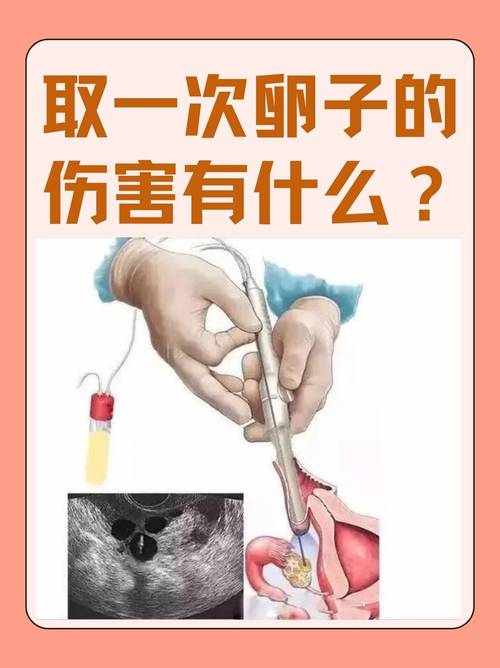 麻醉取卵后会疼几天_麻醉取卵好还是不麻醉好_取卵麻醉