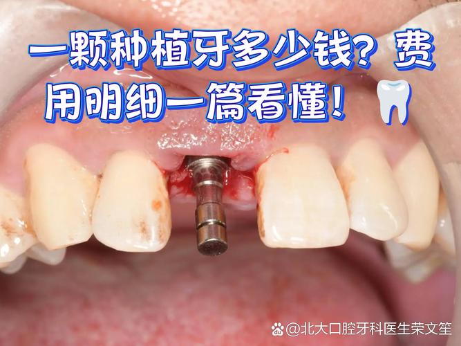 去正规医院种植牙齿多少钱_牙齿种植去哪家医院比较好_做种植牙医院