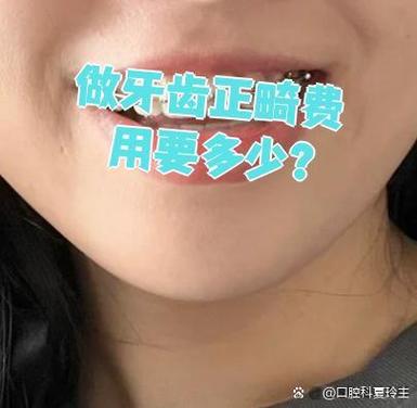 牙齿正畸费用多少_深圳福田罗湖人流费用_深圳福田青少年钢丝正畸费用