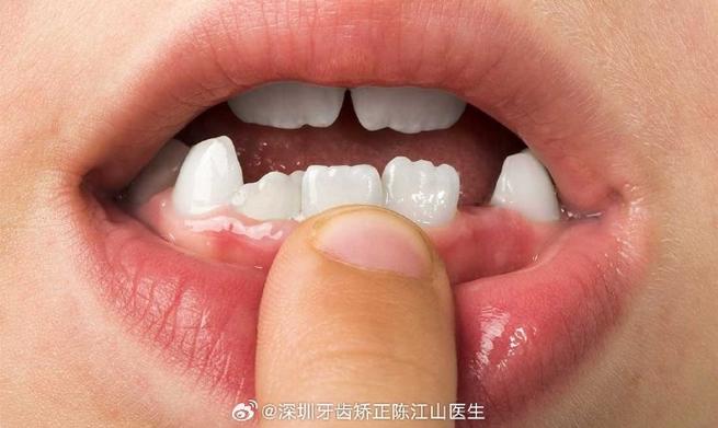 小孩牙齿长成锯齿状,到底严重不严重?