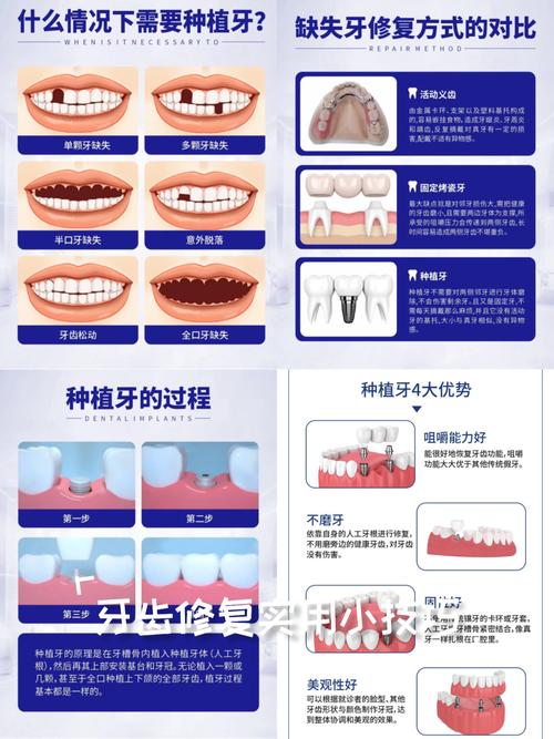 口腔医院种植牙排名_3d种植牙比较专业的口腔医院_口腔种植医院哪家好