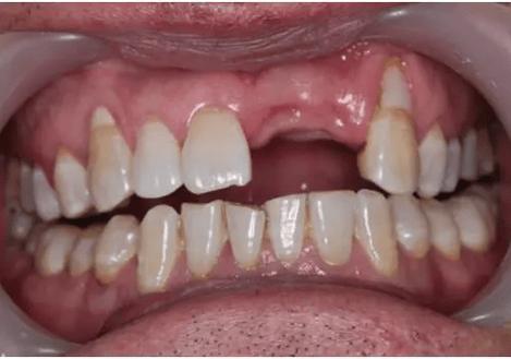 牙齿怎么种植_牙齿种植步骤和流程_牙齿种植价格一般多少钱一颗