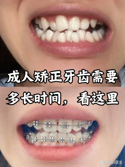 牙齿矫正做可以用医保吗_牙齿矫正做可以吃饭吗_40多岁还可以做牙齿矫正吗