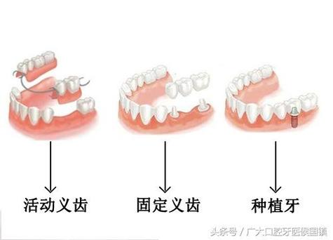 种牙失败取出种植体能不能恢复_种植牙失败后取出种植体_北京种植牙失败修复多少钱 种植体取出