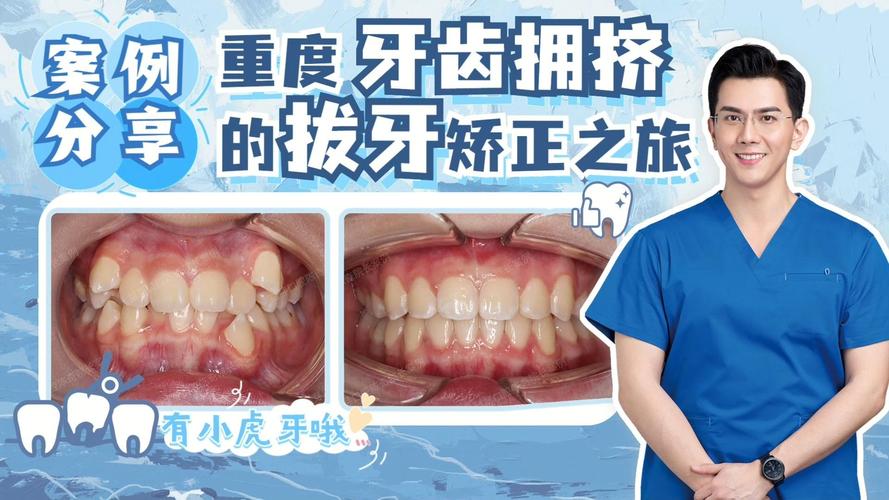 牙齿矫正虎牙快速矫正方法_牙齿矫正虎牙多久能拉下来_虎牙快速牙齿矫正