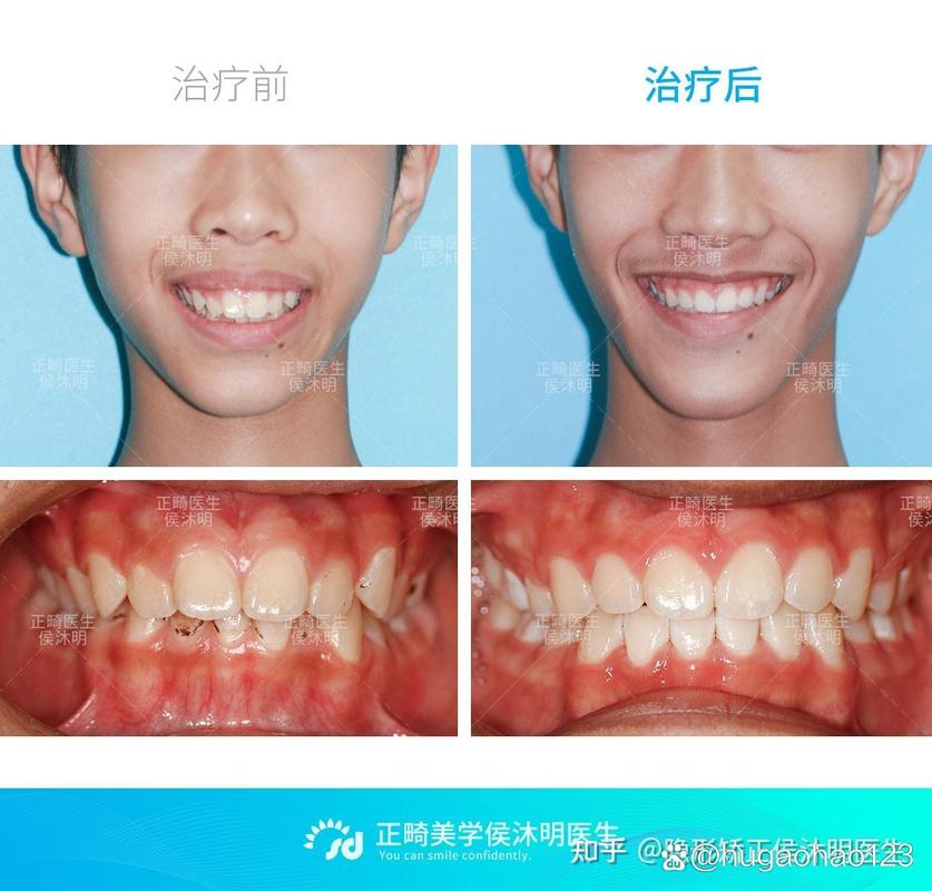 25岁了龅牙可以矫正吗_矫正龅牙可以只矫正上牙吗_矫正龅牙可以只打钉吗