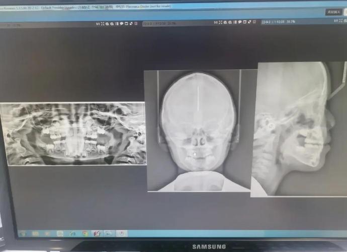 幼儿矫正地包天多少钱_儿童矫正地包天费用_幼儿地包天矫正收费