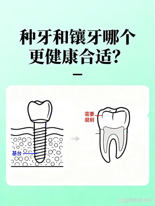 镶牙种牙_种镶牙的价格一般都是多少钱_25岁镶牙还是种牙