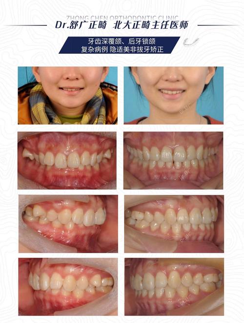 牙齿矫正后还是深覆合_30岁后还能不能矫正牙齿深覆合_覆盖牙齿矫正