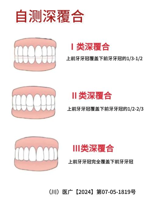 覆盖牙齿矫正_30岁后还能不能矫正牙齿深覆合_牙齿矫正后还是深覆合