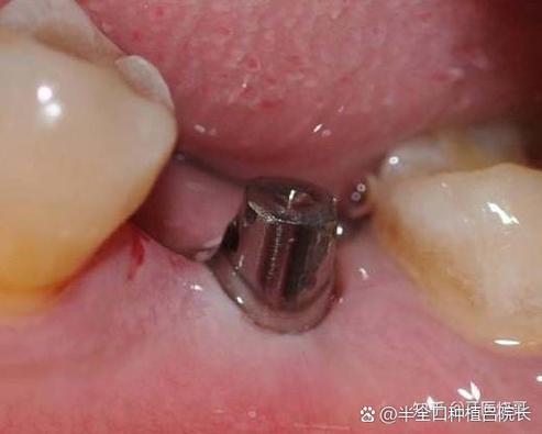 60岁可以种植牙_牙种植可以一次性做完吗_我说种植牙可不可以弄