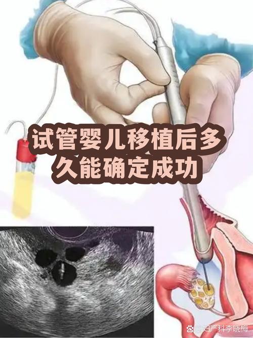 一代试管婴儿能成功吗 看完心里有底