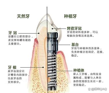 深圳镶牙和植牙多少钱一颗_深圳镶牙和种植牙哪个划算_深圳牙种植价格