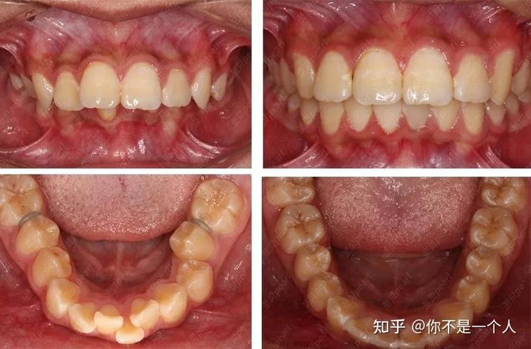 牙齿矫正用的钢丝是什么材料_27岁矫正牙齿还有用吗_牙齿矫正用什么材质的比较好