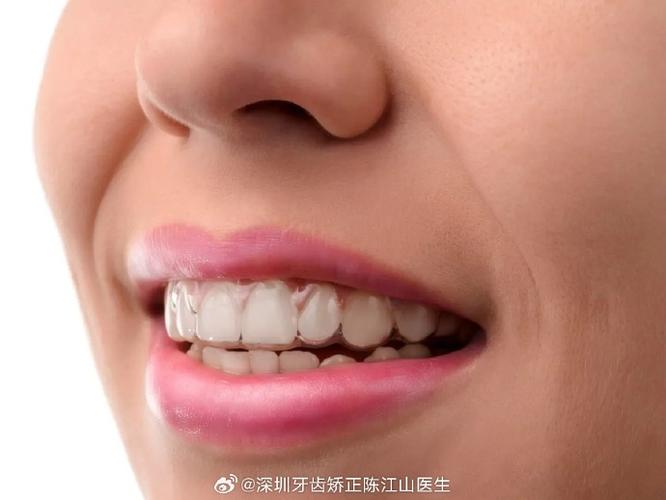 成年牙齿矫正有坏处吗_成年人快速矫正牙齿_成年牙齿矫正费用