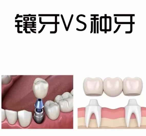长沙种牙和假牙到底选哪个?看完这篇别再花冤枉钱