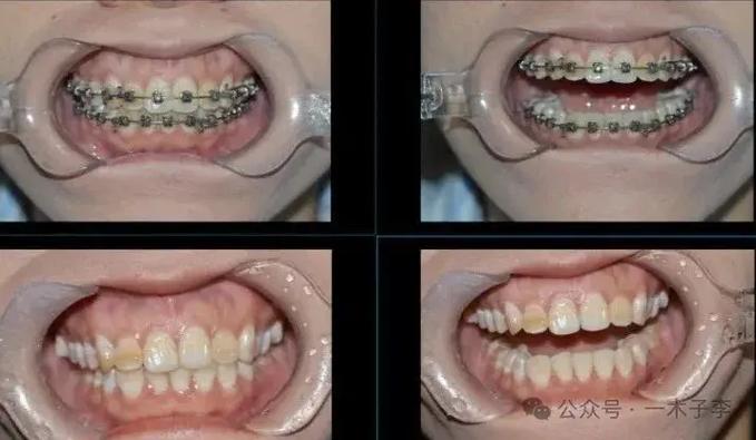 30岁矫正牙齿有什么危害?把坑说透了再决定