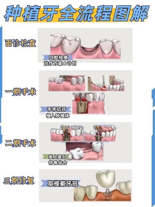 门牙种植期间空着很难看怎么办_门牙掉了怎么种植_种植门牙期间要一直空缺吗
