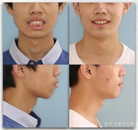 牙齿矫正最好办法_牙齿矫正几种方法效果比较_比较好的牙齿矫正方法