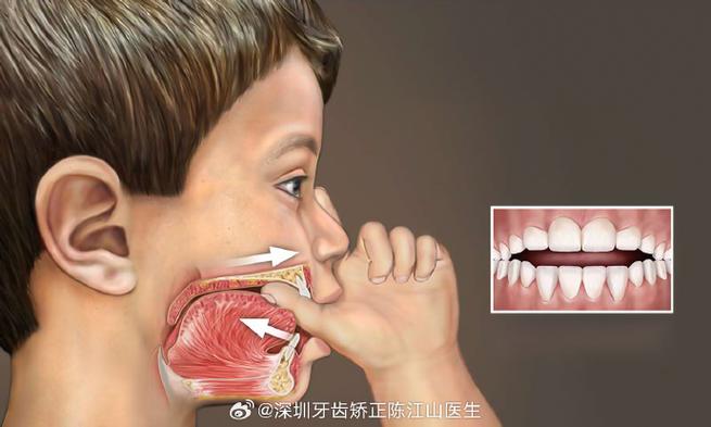 深圳儿童地包天最佳矫正年龄_儿童地包天矫正医院_深圳骨性地包天手术医院