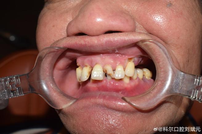 种牙适合哪类人群_76岁适合种牙吗_牙种植好吗