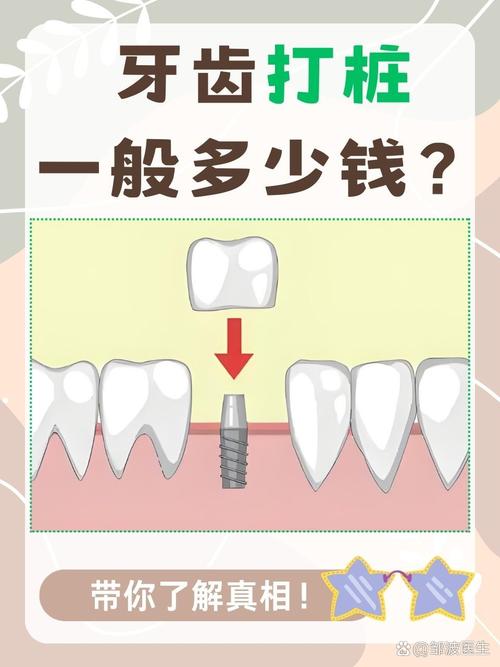牙种植打桩做多久_牙种植打桩做多少钱_打桩做牙和种植牙