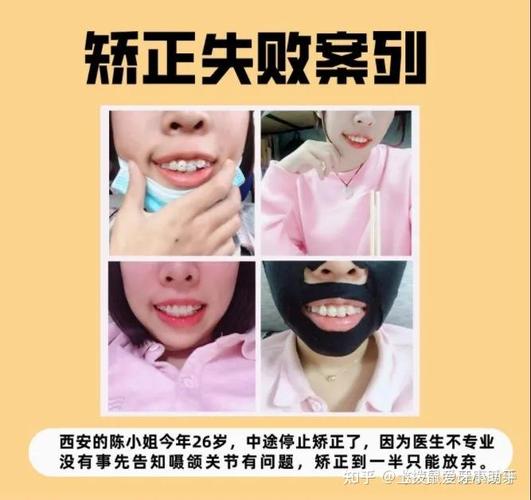 25岁去矫正牙齿_牙齿矫正去医院还是口腔机构_25岁去矫正牙齿
