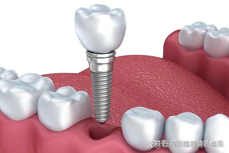 牙齿种植_牙齿种植价钱_咸宁牙齿种植