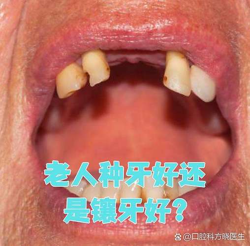 牙齿合适种植牙吗_74岁种植牙齿合适吗_牙齿合适种植什么