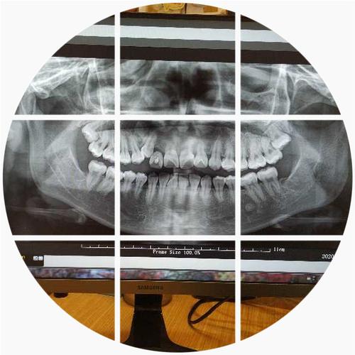 nobel种牙怎么样_nobel种植牙特点_种牙nobelactive