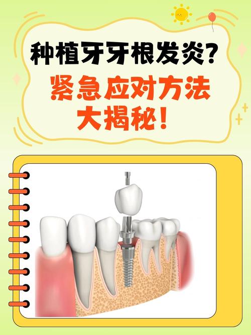 拔牙种植牙需要多久时间_拔牙种植牙医保可以报销吗_拔种植牙吗