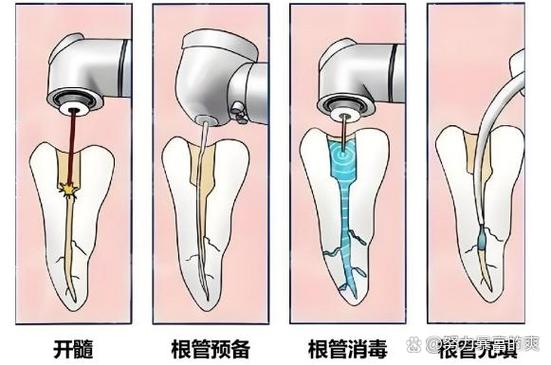 牙齿植根管_根管治疗 植牙_植牙根治疗管用吗