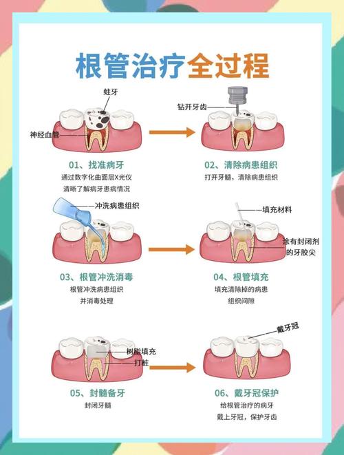 根管治疗 植牙_植牙根治疗管用吗_牙齿植根管