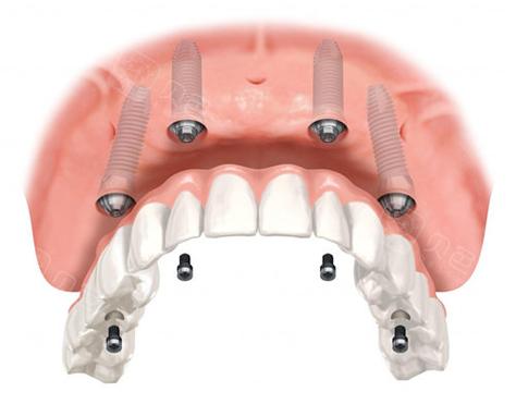 半口种植牙一般种几颗？4颗和6颗哪种更适合你