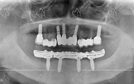 种植牙一般种几颗_种植牙种几颗恢复全口_半口种植牙一般种几颗牙