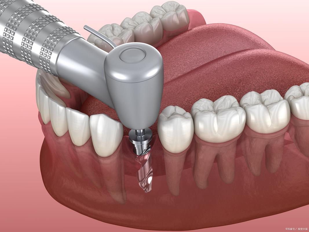 缺一颗牙一定要种吗_缺牙不种牙_牙齿缺失种牙多少钱