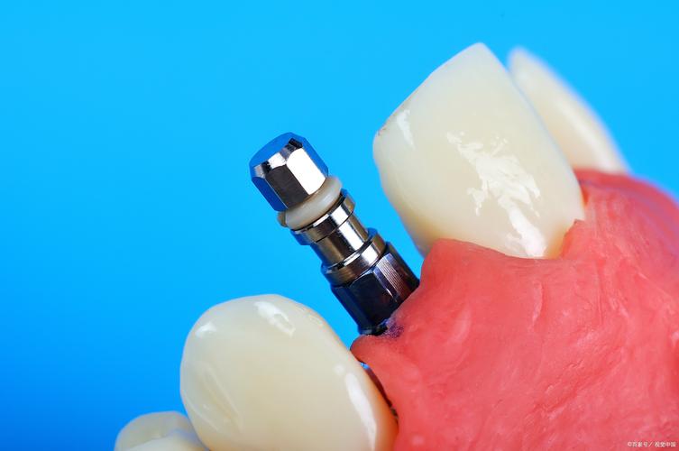 缺牙不种牙_缺一颗牙一定要种吗_牙齿缺失种牙多少钱