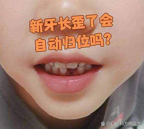 孩子门牙长歪了矫正多少钱_长歪的门牙_六岁孩子门牙长歪了怎么矫正