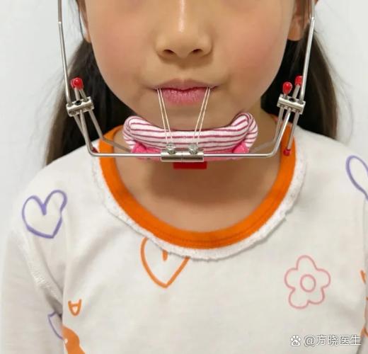 孩子门牙长歪了矫正多少钱_六岁孩子门牙长歪了怎么矫正_长歪的门牙