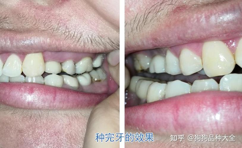 赤峰种植牙医院推荐 公立三甲_赤峰学院附属医院种植牙的价格_赤峰市种牙都有什么价位的