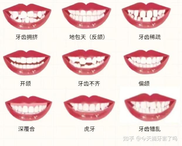 门齿突出矫正大概多少钱_45岁门牙突出最快矫正方法_矫正突出门牙方法图片