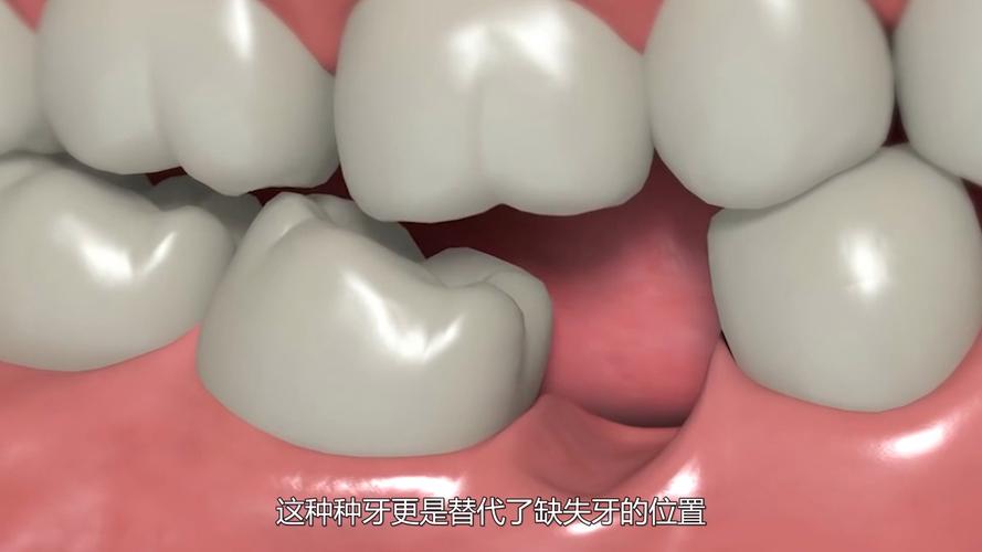 植牙种牙_关于植牙_植牙的流程及步骤