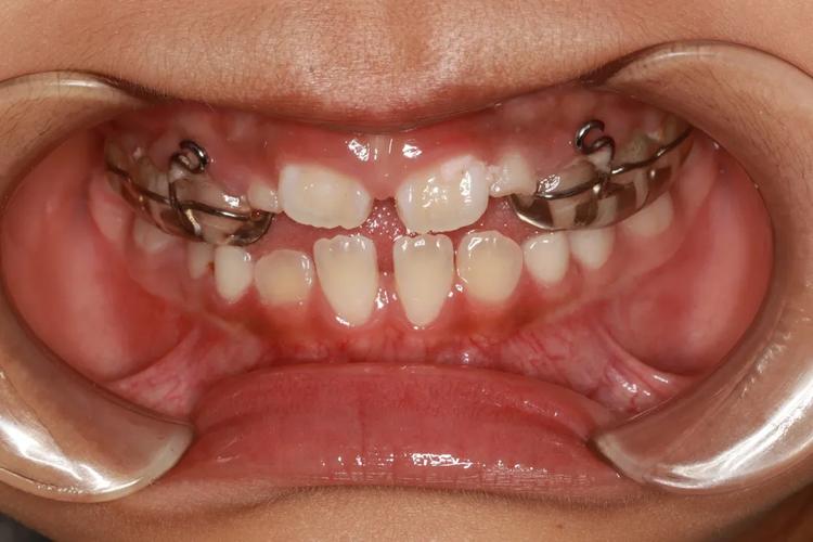 8岁做牙齿矫正会不会太早_过早矫正牙齿_牙齿矫正过早的坏处