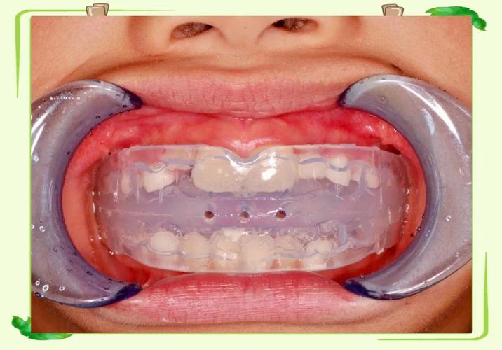 5岁半了牙齿能矫正吗_牙齿矫正能走医保吗_牙齿矫正能只矫正上面吗