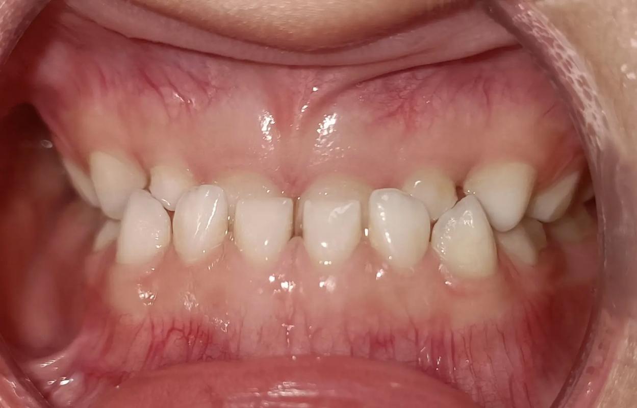 牙齿矫正能只矫正上面吗_牙齿矫正能走医保吗_5岁半了牙齿能矫正吗